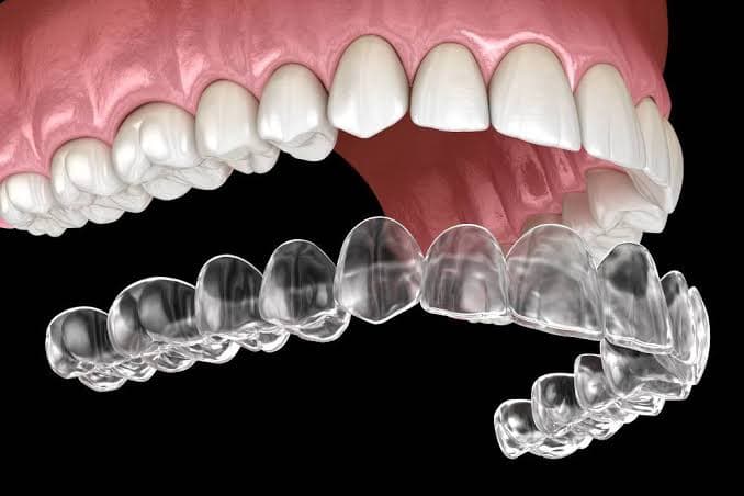 Invisalign®