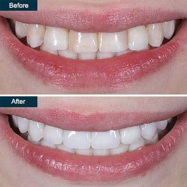 Teeth Whitening